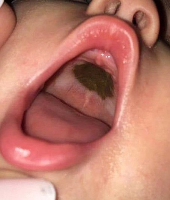 She noticed a black lump in her daughter’s mouth and hurried out and to the hospital.